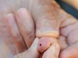 Bấm huyệt Thập tuyên – phòng tai biến, đột quỵ