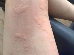 Mề đay mẩn ngứa – chuyện tưởng nhẹ mà hóa nan giải