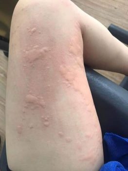 Mề đay mẩn ngứa – chuyện tưởng nhẹ mà hóa nan giải