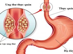 Trào ngược lâu ngày – coi chừng ung thư thực quản