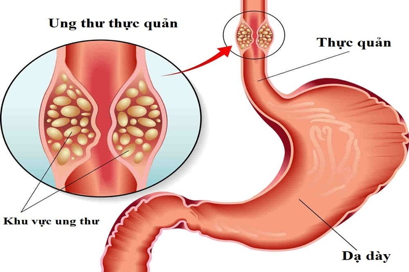 Trào ngược lâu ngày – coi chừng ung thư thực quản