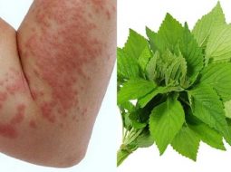 Ngứa mẩn khó chịu: Lão Tuấn bày cách trị mề đay tại nhà