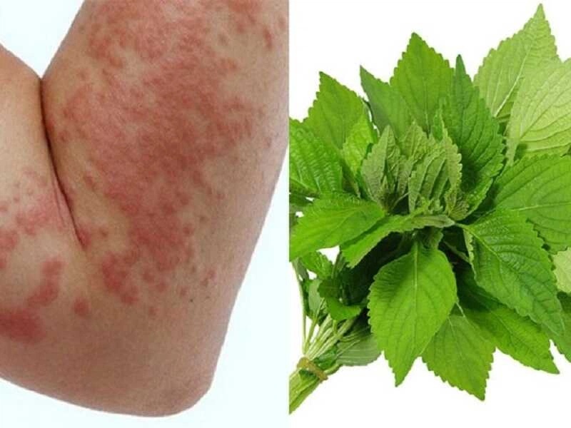 Ngứa mẩn khó chịu: Lão Tuấn bày cách trị mề đay tại nhà