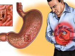 Đừng chủ quan với các dấu hiệu cơn đau dạ dày cấp khó lường