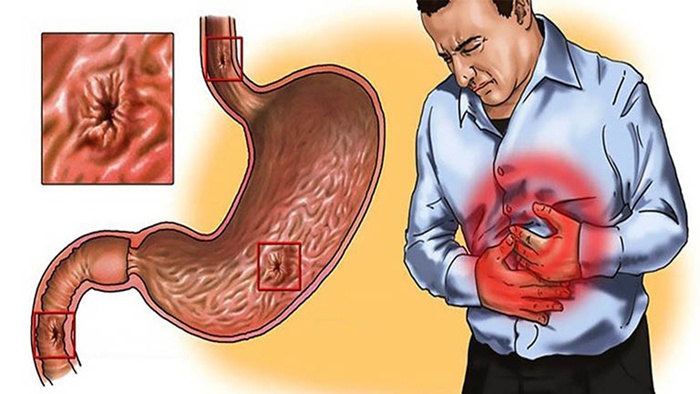 Đừng chủ quan với các dấu hiệu cơn đau dạ dày cấp khó lường