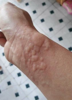 5 dấu hiệu nổi mề đay do gan “nóng” chứ không phải dị ứng