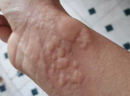 5 dấu hiệu nổi mề đay do gan “nóng” chứ không phải dị ứng