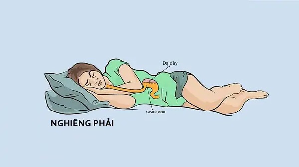 Trào ngược khi ngủ: Đừng tưởng nghỉ ngơi là dạ dày cũng nghỉ