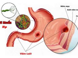 6 thói quen "nuôi dưỡng" vi khuẩn HP hại dạ dày