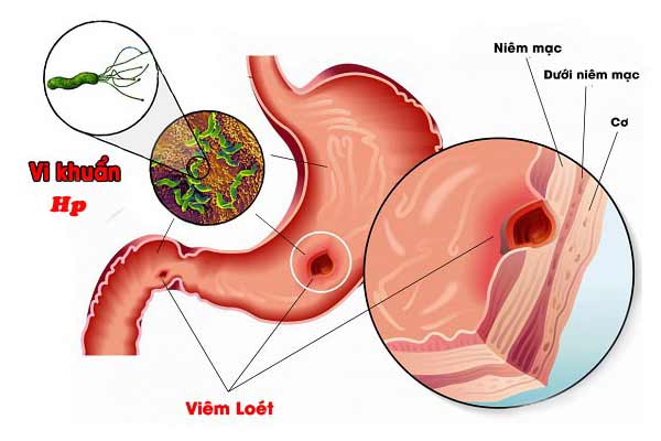 6 thói quen "nuôi dưỡng" vi khuẩn HP hại dạ dày
