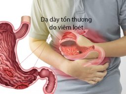 Dấu hiệu viêm loét dạ dày – Đừng để “âm ỉ” thành mạn tính
