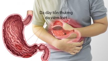 Dấu hiệu viêm loét dạ dày – Đừng để “âm ỉ” thành mạn tính