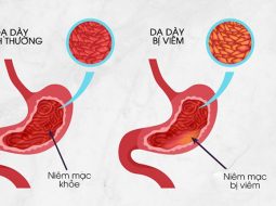 Viêm dạ dày: Căn bệnh dễ lơ là, khó chữa lành nếu chủ quan