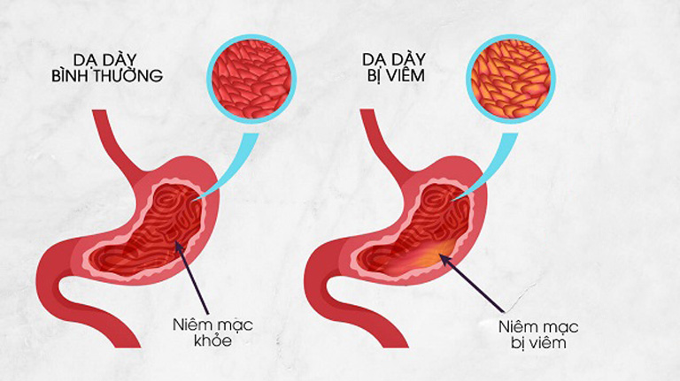 Viêm dạ dày: Căn bệnh dễ lơ là, khó chữa lành nếu chủ quan