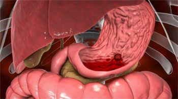 Cảnh báo tình trạng xuất huyết dạ dày nguy hiểm khôn lường