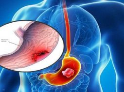 Viêm dạ dày mạn tính: Bệnh của thói quen và tỳ vị hư tổn