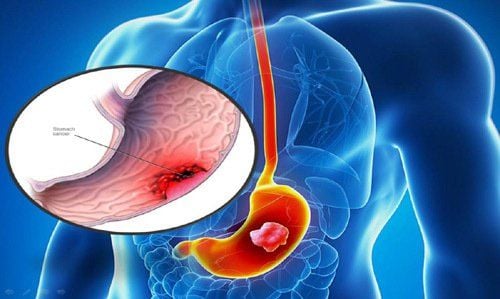 Viêm dạ dày mạn tính: Bệnh của thói quen và tỳ vị hư tổn