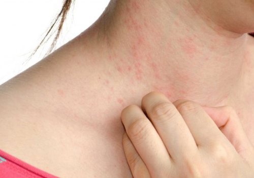 Dị ứng thời tiết
