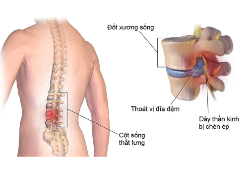Thoát vị đĩa đệm