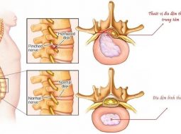 Bệnh thoát vị đĩa đệm có nguy hiểm không? 6 biến chứng cần phòng ngừa