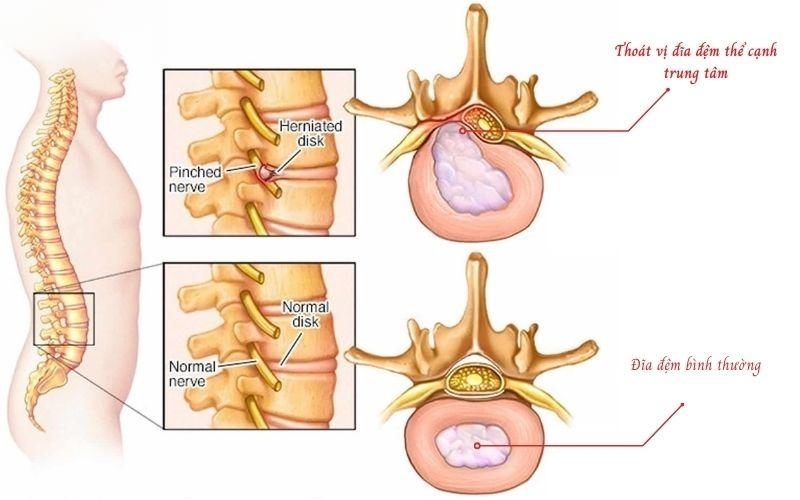 Bệnh thoát vị đĩa đệm có nguy hiểm không? 6 biến chứng cần phòng ngừa