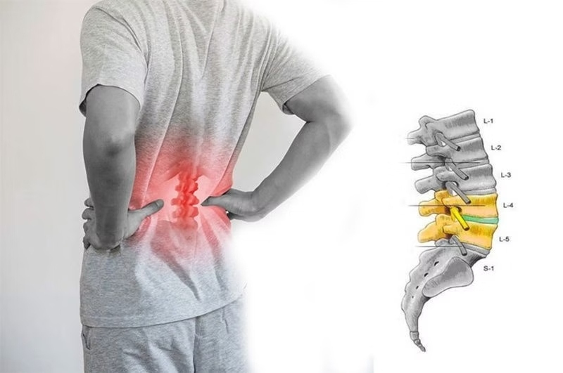 Cách chữa phồng đĩa đệm bằng các liệu pháp dân gian – hiệu quả và an toàn