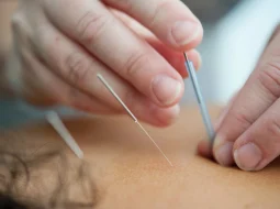 Cơ chế tác dụng của phương pháp cấy chỉ chữa thoái hóa đốt sống cổ