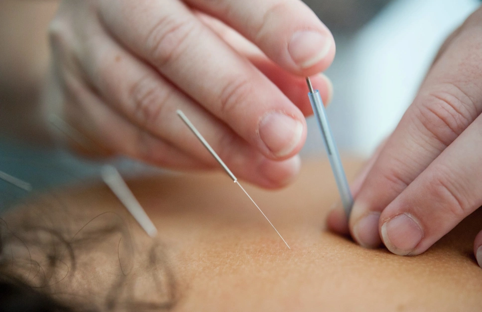 Cơ chế tác dụng của phương pháp cấy chỉ chữa thoái hóa đốt sống cổ