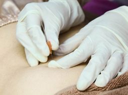 Cấy chỉ chữa thoát vị đĩa đệm: Giảm đau nhanh, tăng lưu thông, phục hồi chức năng