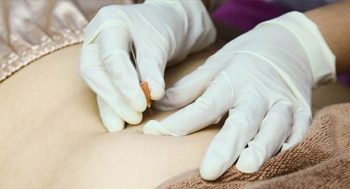 Cấy chỉ chữa thoát vị đĩa đệm: Giảm đau nhanh, tăng lưu thông, phục hồi chức năng