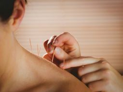 Châm cứu chữa thoát vị đĩa đệm: Cơ chế điều trị và quy trình kỹ thuật