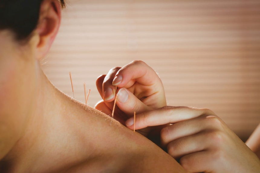 Châm cứu chữa thoát vị đĩa đệm: Cơ chế điều trị và quy trình kỹ thuật