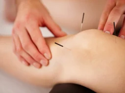 Châm cứu đúng cách giúp giảm đau thoái hóa khớp gối