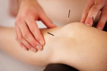 Châm cứu đúng cách giúp giảm đau thoái hóa khớp gối