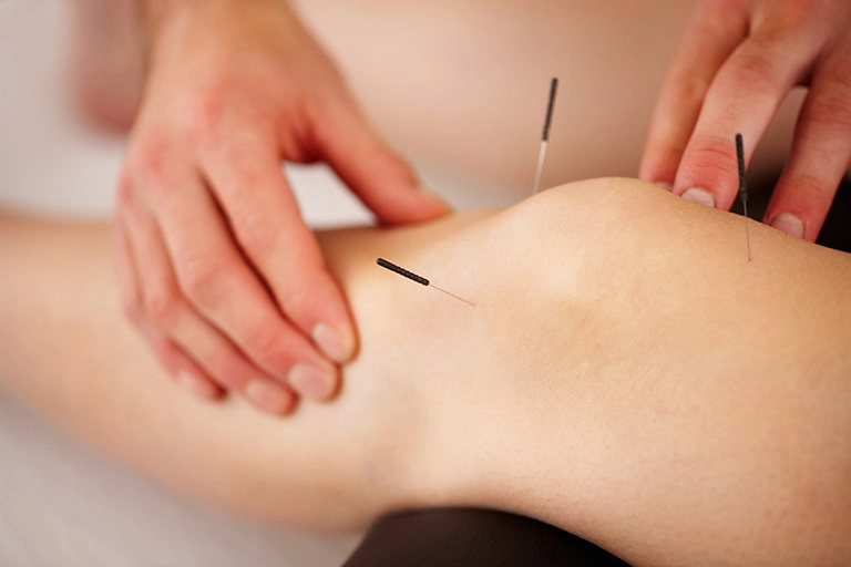 Châm cứu đúng cách giúp giảm đau thoái hóa khớp gối