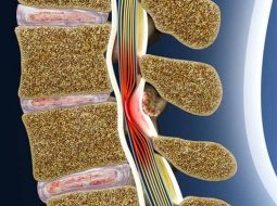 Hẹp ống sống: dấu hiệu, nguyên nhân và hướng chăm sóc tự nhiên