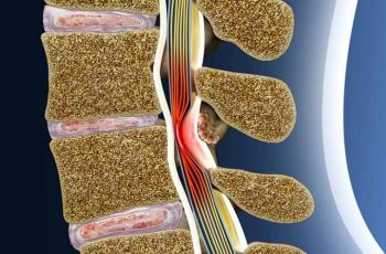 Dấu hiệu bệnh hẹp ống sống, nguyên nhân và hướng cải thiện