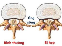 Hẹp ống sống cổ: Nguyên nhân, triệu chứng và giải pháp chăm sóc hiệu quả