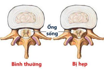 Nguyên nhân, triệu chứng hẹp ống sống cổ và cách hồi phục cải thiện
