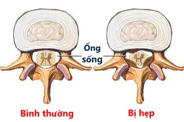 Hẹp ống sống cổ: Nguyên nhân, triệu chứng và giải pháp chăm sóc hiệu quả