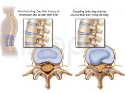 Hẹp ống sống thắt lưng: triệu chứng, nguyên nhân và hướng điều trị