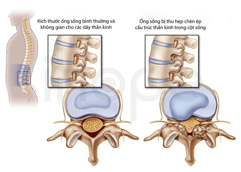 Hẹp ống sống thắt lưng: triệu chứng, nguyên nhân và hướng điều trị