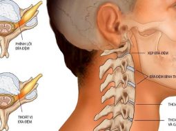 Lồi đĩa đệm cột sống cổ: nguyên nhân, dấu hiệu & cách điều trị