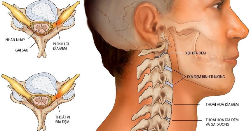 Lồi đĩa đệm cột sống cổ: nguyên nhân, dấu hiệu & cách điều trị