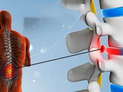 Nguyên nhân, triệu chứng lồi đĩa đệm L5 S1 và điều trị yhct