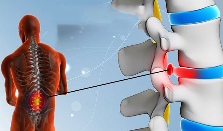 Nguyên nhân, triệu chứng lồi đĩa đệm L5 S1 và điều trị yhct