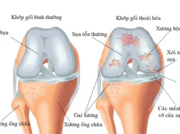 Phác đồ điều trị thoái hóa khớp gối dựa trên các nguyên tắc nào