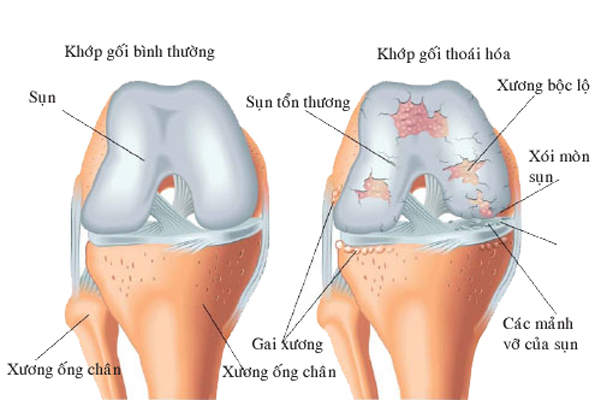 Thoái hóa khớp