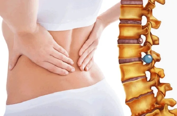 Phồng đĩa đệm: Nguyên nhân dấu hiệu và cách điều trị cổ truyền hiệu quả