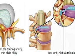 Rách bao xơ đĩa đệm có lành được không – Cách phục hồi và kiểm soát hiệu quả